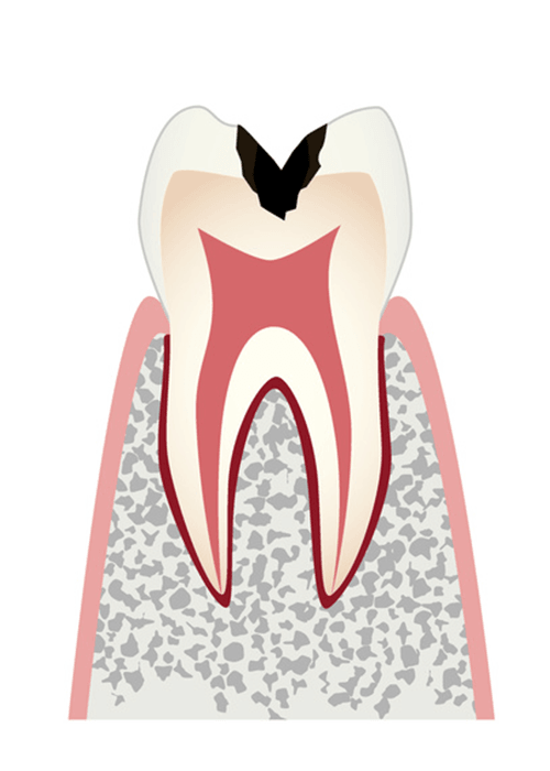 C2 歯の内部（象牙質）まで進行したむし歯