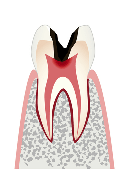 C3 神経まで進行したむし歯