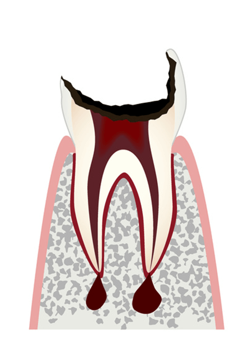 C4 歯根まで進行したむし歯